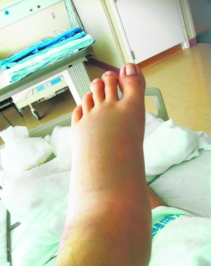 跟骨病中医治疗