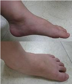 哪些症状属于跟骨病