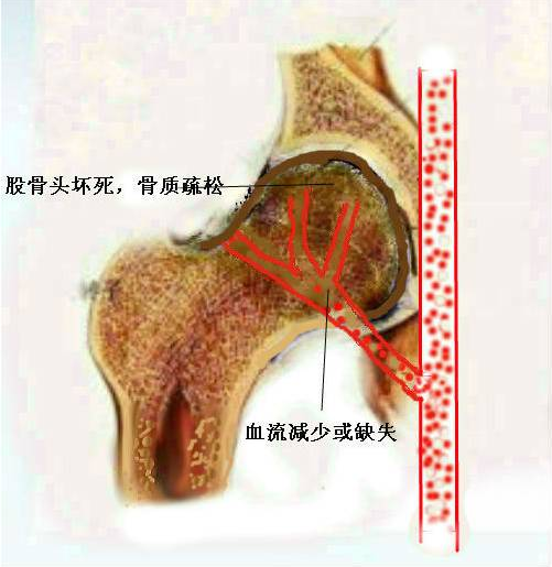 造成股骨头坏死原因